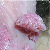 زگیل تناسلی پاکسازی کامل