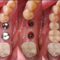 دندانپزشکی مرکز تخصصی ایمپلنت در تبریز|خدمات آرایشگری و زیبایی|مرند, |دیوار