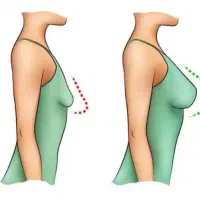 پروتز سینه و کارهای سیلیکونی و ژله ای
