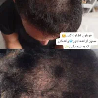 پی ارپی صورت ومو ومزوتراپی صورت ومو تخفیف ویژه|خدمات آرایشگری و زیبایی|کازرون, |دیوار