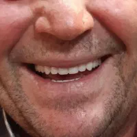 ترمیم عصب کشی روکش کامپوزیت زیبایی|خدمات آرایشگری و زیبایی|اردبیل, |دیوار