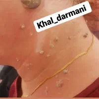 برداشتن خال زگیل و میخچه با محلول صدرصد گیاهی|آرایشی، بهداشتی، درمانی|ایذه, |دیوار