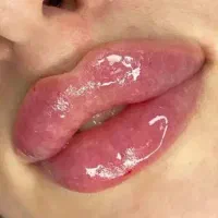 ژل لب و بوتاکس سی‌سی 700 کلینیک