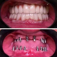 دندانپزشکی مرکز تخصصی ایمپلنت در تبریز