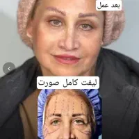 بلفارو/غبغب/سانترال/چشم گربه ایی/فیلر بادی و بکینی|خدمات آرایشگری و زیبایی|اهواز, کیانپارس |دیوار