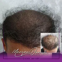 میکرواسکالپ سر ،اسکالپ سر ، پرپشتی مو در مطب پزشک|خدمات آرایشگری و زیبایی|اهواز, کیانپارس |دیوار