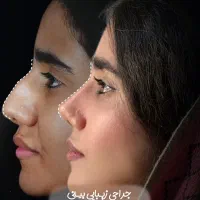 جراحی زیبایی بینی فقط با ۵۰ میلیون