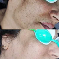 ریموو تتو و رفع تیرگی بدن در مطب پزشک|خدمات آرایشگری و زیبایی|آبادان, |دیوار