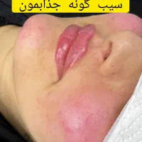 تزریقات تخصصی ژل و بوتاکس|خدمات آرایشگری و زیبایی|اهواز, شهرک دانشگاه|دیوار