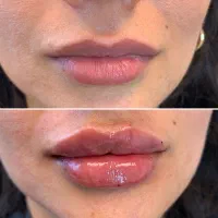 تزریق ژل 300 بوتاکس 350مزو نخ کانتورینگ