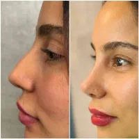 شرایط جدید اقساط برای جراحی بینی