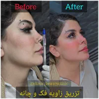 تزریق فیلر کره ای با تخفیف ویژه فقط تا اخر هفته