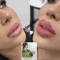 تزریق ژل و بوتاکس و آموزش حرفه ای|خدمات آرایشگری و زیبایی|اهواز, سپیدار|دیوار
