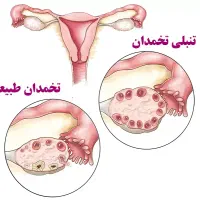 درمان تنبلی تخمدان