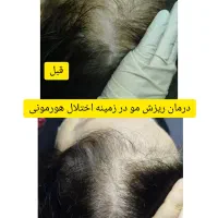 درمان ریزش مو