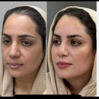 مدل برای جوانسازی وچروک و لک، زیبایی حق شماست