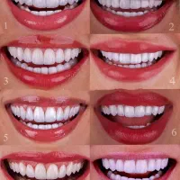 کامپوزیت دندان جشنواره لمینت ایمکس|خدمات آرایشگری و زیبایی|تهران, شمس‌آباد|دیوار