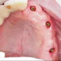 ترمیم عصب کشی روکش کامپوزیت زیبایی|خدمات آرایشگری و زیبایی|اردبیل, |دیوار