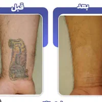 حذف تتو در مطب با دستگاه کیوسوییچ امریکایی