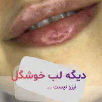 فیلر بادی،جراحی پلک،تزریق چربی،لب روسی