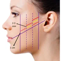 آموزش تضمینی تزریق ژل و بوتاکس