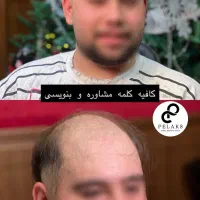 پروتز مو مردانه ( خداحافظ کچلی)