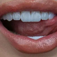 کامپوزیت زیبایی با تخفیف به مدت محدود