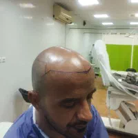 کشت مو ب روش fit