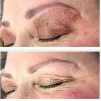 خالبرداری ،رفع کک ومک ،برداشتن میخچه توسط پزشک|خدمات آرایشگری و زیبایی|کرج, شهرک یاس جنوبی|دیوار