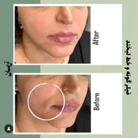 کانتورینگ با فیلر و ژل و لب تخصصی (کاملا طبیعی)|خدمات آرایشگری و زیبایی|مشهد, گلبرگ شمالی|دیوار