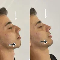 ویژه اقایان آف بوتاکس فیلر و پاکسازی|خدمات آرایشگری و زیبایی|کرج, گلشهر|دیوار