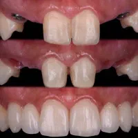 ایمپلنت دندان کره ای و سوئیسی با تخفیف پاییزه|خدمات آرایشگری و زیبایی|قرچک, پارس سرام|دیوار