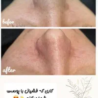 پاکسازی جوانسازی پوست و خالبرداری و مزو و بوتاکس|خدمات آرایشگری و زیبایی|سمنان, |دیوار