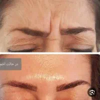 شیدینگ لب بوتاکس