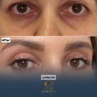 بلفارو پلاستی رفع پف+ پی ار پی هدیه +۸ میلیون