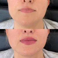 تزریق چربی و فیلربیکینی بانوان و آقایان/ساکشن چربی|خدمات آرایشگری و زیبایی|سقز, |دیوار