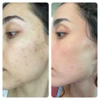 پاکسازی و فیشال پوست تخصصی بانوان رشت|خدمات آرایشگری و زیبایی|رشت, گلباغ نماز|دیوار
