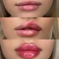 آف آموزش و تزریق فوق تخصصی فیلر بوتاکس(بمدت محدود)