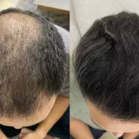 کاشت مو فقط ۲۰ میلیون