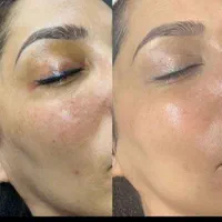 فیشیال و پاکسازی تخصصی پوست|خدمات آرایشگری و زیبایی|قم, قلعه کامکار|دیوار