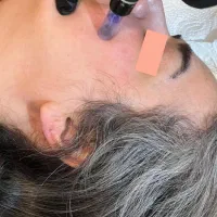 مزونیدلینگ صورت(جوان‌سازی،برطرف کردن جای جوش و لک)|خدمات آرایشگری و زیبایی|بابل, |دیوار