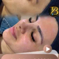 روشن‌کننده هایفو لیزرموزائد پی‌آر‌پی حجم‌سینه‌باسن|خدمات آرایشگری و زیبایی|تهران, صادقیه|دیوار