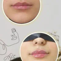 پاک کردن انواع تتو و خالکوبی بالیزر تخصصی کیوسویچ|خدمات آرایشگری و زیبایی|فولادشهر, پارک کوهستان|دیوار