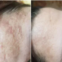 جوانسازی صورت با بهترین متریال و بروز ترین دستگاه|خدمات آرایشگری و زیبایی|گرگان, |دیوار