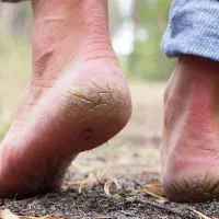 درمان ترک پا