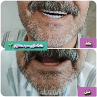 دندان مصنوعی/ ضمانتی / ایتالیایی/ جوان پسند|خدمات آرایشگری و زیبایی|مشهد, امام رضا (ع)|دیوار