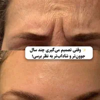 تزریق بوتاکس با بهترین متد|خدمات آرایشگری و زیبایی|مشهد, مصلی (کارمندان اول)|دیوار