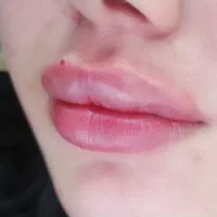 تزریق ژل بادی(ژل باسن و هیپ دیپ و..)