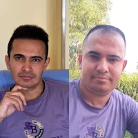اموزش تخصصی و اصولی کاشت مو(تعداد محدود)
