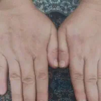 کوچک کردن بینی.رفع افتادگی‌پلک و چروک صورت|خدمات آرایشگری و زیبایی|زاهدان, |دیوار